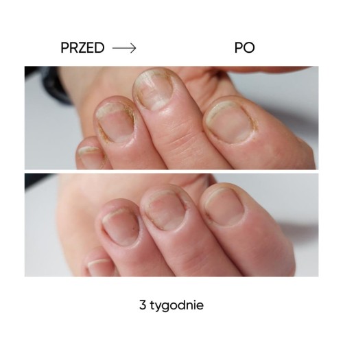 NAILSOFTHEDAY Onistop – olejek przeciwko onycholizie, 8 ml 2