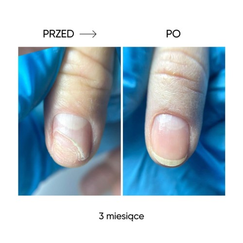 NAILSOFTHEDAY Onistop – olejek przeciwko onycholizie, 8 ml 7