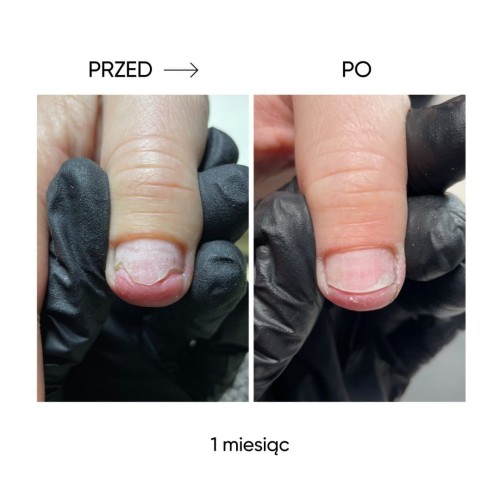 NAILSOFTHEDAY Onistop – olejek przeciwko onycholizie, 8 ml 8